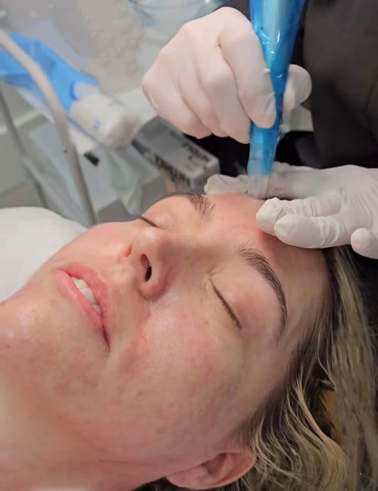 MICRONEEDLING (COLLAGEN INDUCTION THERAPY)